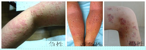 皮肤上出现湿疹患者应该如何护理