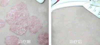 重庆治疗牛皮癣案例图,牛皮癣症状,牛皮癣偏方,牛皮癣治疗效果图