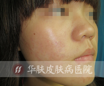 重庆治疗青春痘_痘痘_痘印痘坑_痤疮最好的医院(重庆祛痘最好的医院)
青春痘案例图_祛痘效果图_重庆治疗青春痘医院