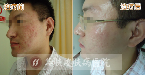 重庆治疗青春痘_痘痘_痘印痘坑_痤疮最好的医院(重庆祛痘最好的医院)青春痘案例图_祛痘效果图_重庆治疗青春痘医院