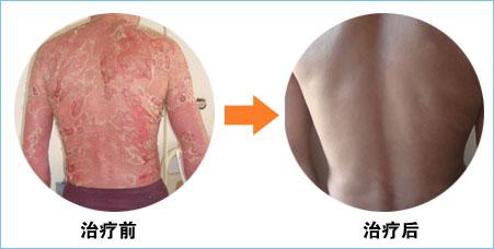 重庆皮肤病医院