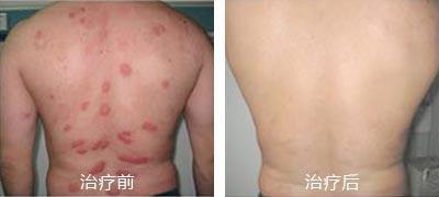 重庆治疗牛皮癣案例图,牛皮癣症状,牛皮癣偏方,牛皮癣治疗效果图