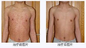 重庆皮肤病医院治疗鱼鳞病的案例,鱼鳞病的症状,鱼鳞病的病因,治疗鱼鳞病的效果