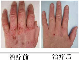 治疗湿疹最好的医院在哪_地址_电话,重庆皮肤科医院