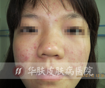 重庆治疗青春痘_痘痘_痘印痘坑_痤疮最好的医院(重庆祛痘最好的医院)青春痘案例图_祛痘效果图_重庆治疗青春痘医院