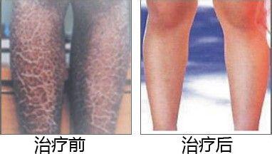 重庆皮肤病医院治疗鱼鳞病的案例,鱼鳞病的症状,鱼鳞病的病因,治疗鱼鳞病的效果