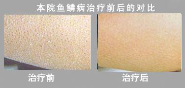 重庆皮肤病医院治疗鱼鳞病的案例,鱼鳞病的症状,鱼鳞病的病因,治疗鱼鳞病的效果