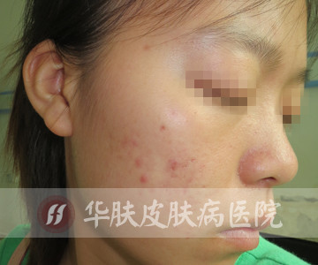 重庆治疗青春痘_痘痘_痘印痘坑_痤疮最好的医院(重庆祛痘最好的医院)青春痘案例图_祛痘效果图_重庆治疗青春痘医院