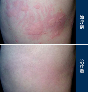 荨麻疹案例,荨麻疹病因,荨麻疹治疗方法_重庆荨麻疹医院
