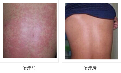 荨麻疹案例,荨麻疹病因,荨麻疹治疗方法_重庆荨麻疹医院