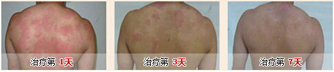 生活中患了荨麻疹我们应该注意哪些