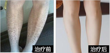 重庆鱼鳞病医院,治疗鱼鳞病最好的医院,重庆皮肤病医院_皮肤科_预约挂号